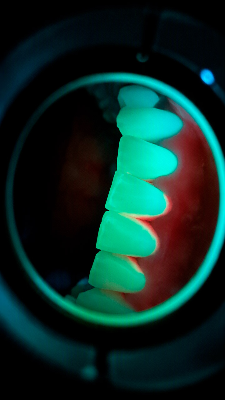 Fluorescência dental observada com o EVINCE