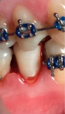 Foto-hemostasia em Dentística Restauradora — caso clínico 1