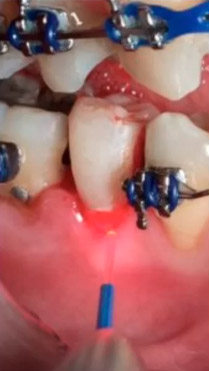 Foto-hemostasia em Dentística Restauradora — caso clínico 2
