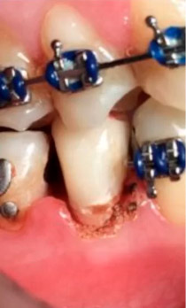Foto-hemostasia em Dentística Restauradora — caso clínico 3