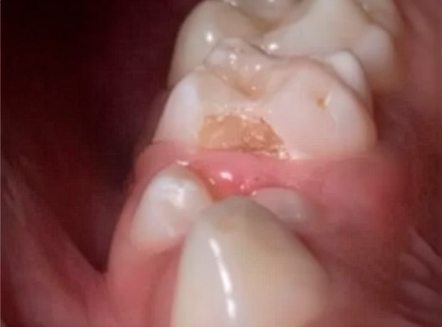 Vaporização de Cárie em Dente Decíduo