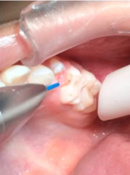 Vaporização de Cárie em Dente Decíduo