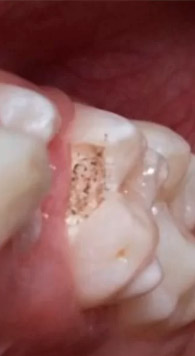 Vaporização de Cárie em Dente Decíduo