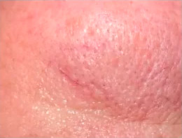 Fotoesclerose de Telangiectasias — caso clínico 1
