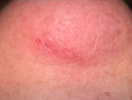 Fotoesclerose de Telangiectasias — caso clínico 3